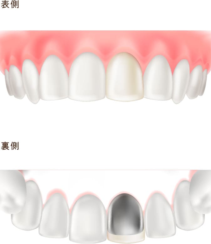 硬質レジン前装冠（前歯のみ）