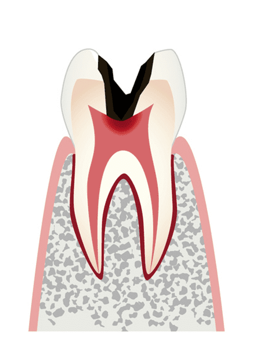 神経まで進行した虫歯